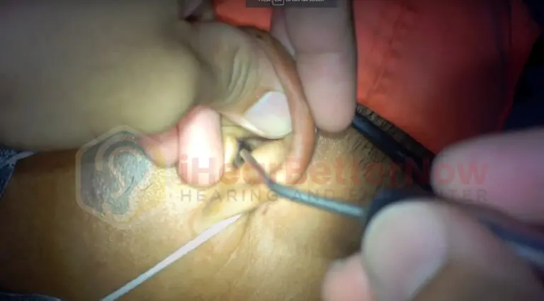 Patient receiving safe earwax removal at iHearBetterNow Hearing and ENT Center Cebu